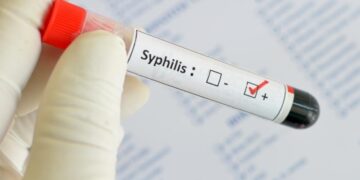 Išaugo sergamumas sifiliu