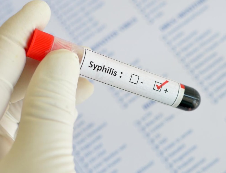 Išaugo sergamumas sifiliu